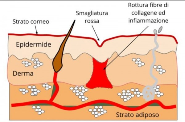 Smagliature_rosse_struttura_derma.jpg